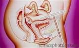 Pictures of Copper Wire Iud Pictures of Copper Wire Iud