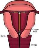 Copper Wire Iud Photos Copper Wire Iud Photos